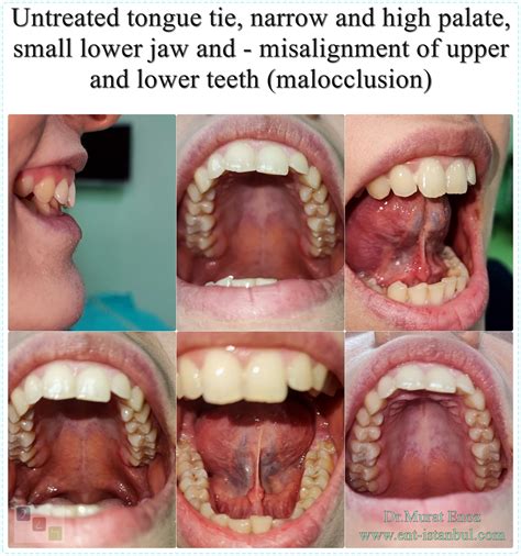 Causes, Symptoms and Treatment of "High-Arched Palate"
