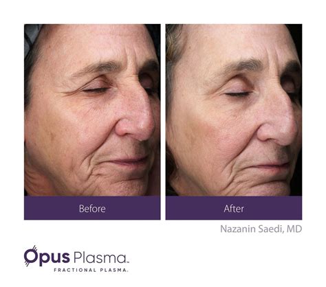 Schaumburg, IL | Alma Opus® | Horizon Medical Center