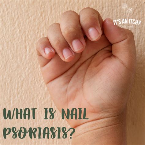 Psoriasis Nails Mild