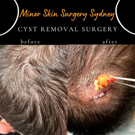 Cyst Surgery, Cyst Removal, Cyst Treatment Sydney