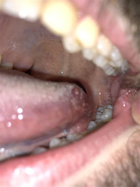 Any idea what this random red bump on the back of my tongue is ...