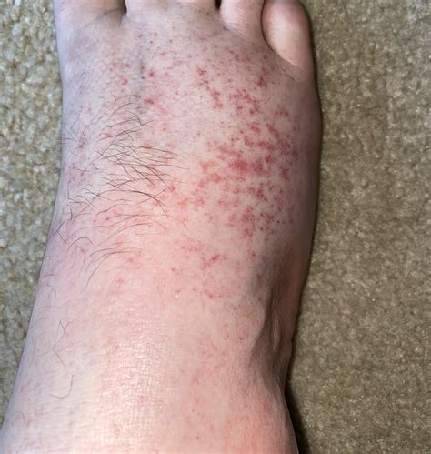 Heat Rash On Feet After Shower at Raven Long blog