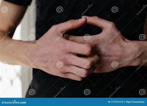 Cracked, Flaky Skin on the Hands. Dermatological Problems of Psoriasis. Hard, Cracked Skin on ...