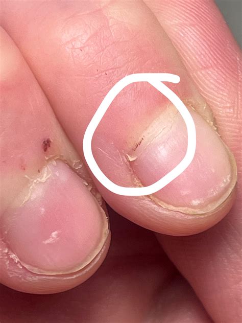 Splinter Hemorrhages Nail Bed