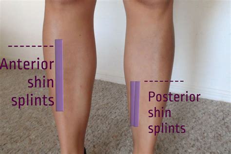 Posterior Shin Splints Bumps