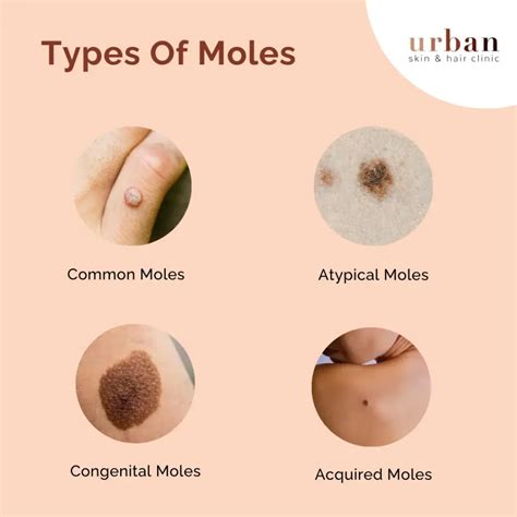 Different Types Of Moles Moles NHS