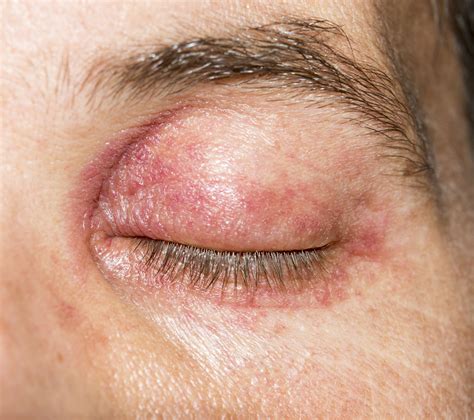 Eyelid Dermatitis (Eczema): Causes, Treatment, and More - Verywell Health