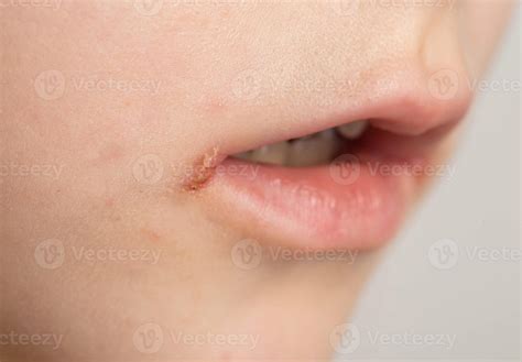 Pain and itching in the corners of the lips of a girl's mouth. Seizures ...