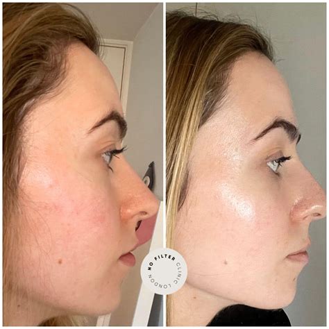 Fire and Ice Facial Treatment London | Skin Resurfacing