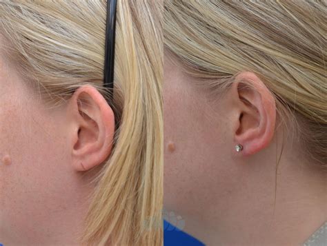 Earlobe Repair Before and After Pictures Case 79 | Charlotte, NC | Dilworth Facial Plastic Surgery