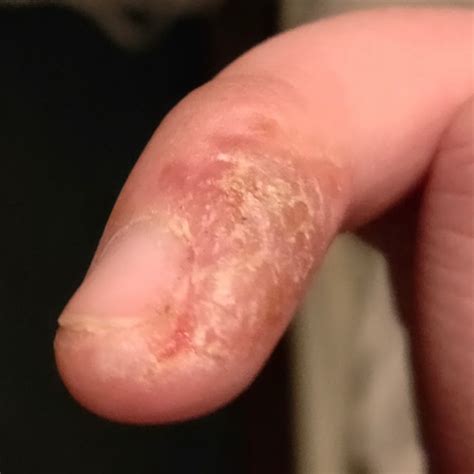 Eczema (ICD-11: EA8Z / ICD-10: L20) 🚨 - Online AI Dermatologist