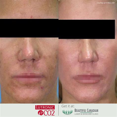 Vancouver Fractional CO2 Laser | Skin Resurfacing Surrey, Delta, Langley