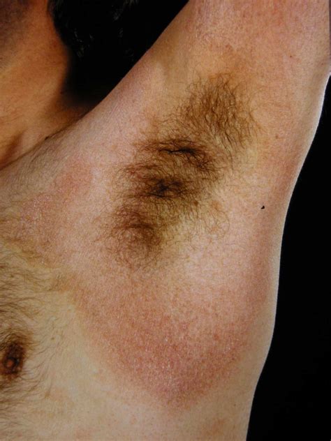 What's Causing Your Underarm Rash?