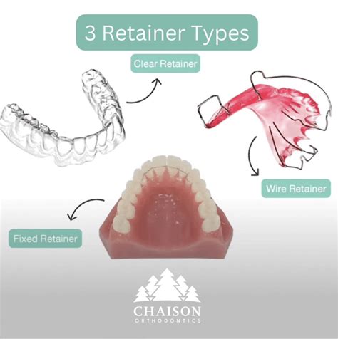3 Retainer Types - Chaison Orthodontics