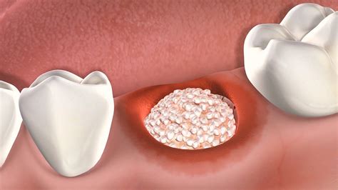 Bone Grafting — SD Oral Surgery