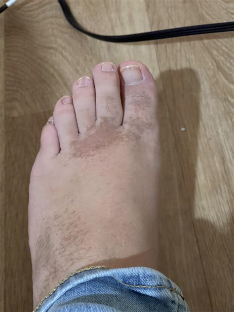 Brown spots / freckles on top of feet by toes and on the side. no ...