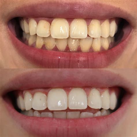 How to Remineralize Teeth Naturally: 5 Proven Methods