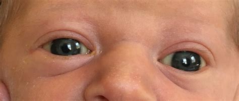 Pediatric Pearls: Infant's Eye Part 2 - Color, Discharge and Red Reflexes