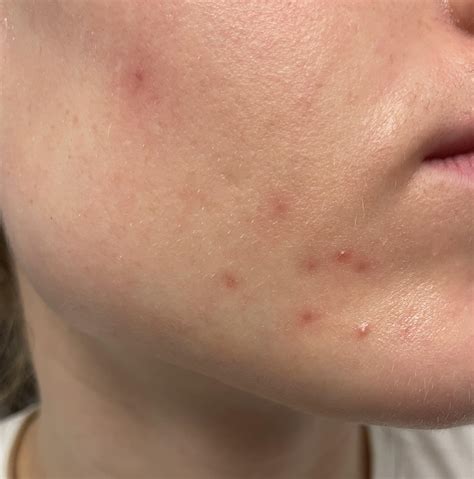 Two hard little bumps on chin. What are they? : r/tretinoin