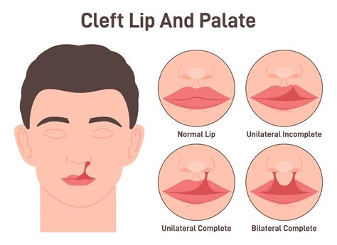 Bilateral Cleft Lip Palate