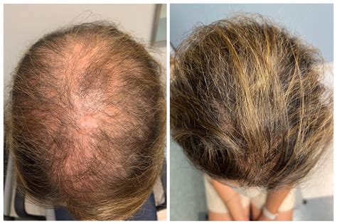 Can Minoxidil Slow Down Hair Loss - Infoupdate.org