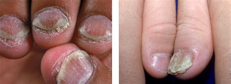 Psoriasis Nails vs. Fungus: Pictures and Differences - GoodRx