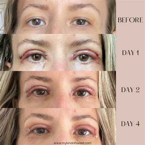 Upper And Lower Eyelid Surgery Before And After Photos You - Infoupdate.org