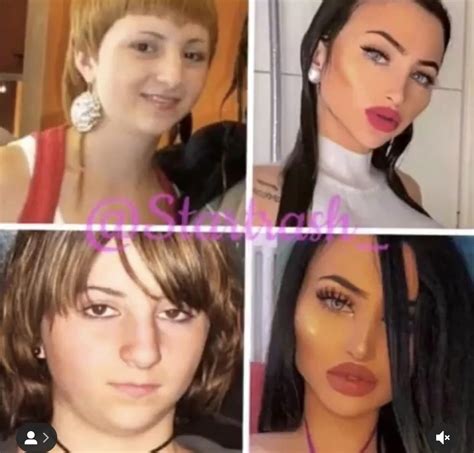 Kesha Nose Job Before And After