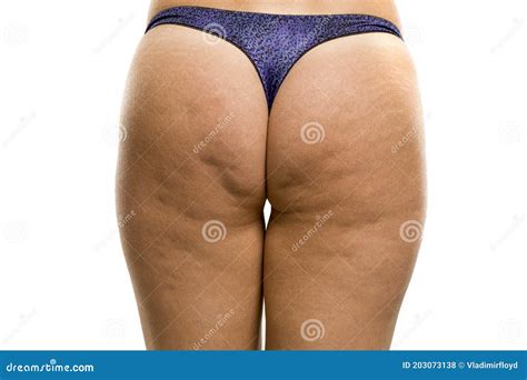 Female Buttocks with Cellulite and Stretch Marks Stock Photo - Image of people, white: 203073138