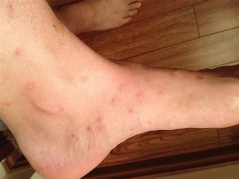 Identifying Insect Bites: 17 Pictures of Common Bug Bites