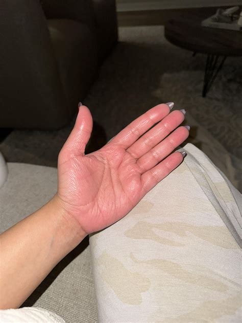 dyshidrotic eczema, mouth ulcers, lie bumps on tongue : r/medical