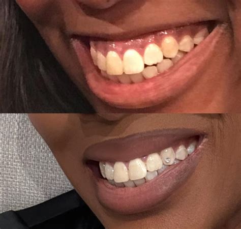 Lip Flip: Cosmetic Procedure, Cost, and Risks