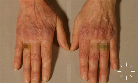 DermaCompass - Acrodermatitis chronica atrophicans