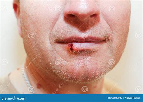 Infected Bitten Lip