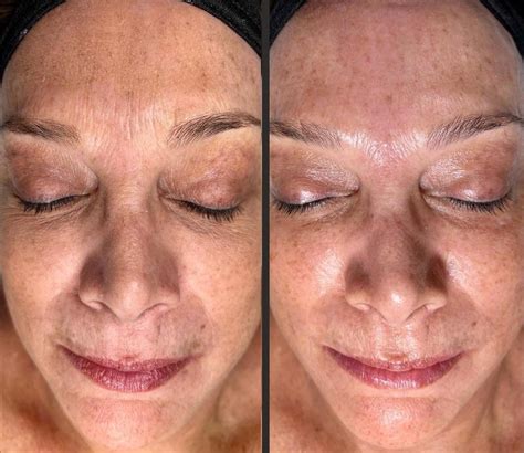 Hydrafacial NYC - Results, Costs & Benefits