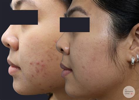 #1 Best Treatment For Post-Inflammatory Acne Scars (PIH)