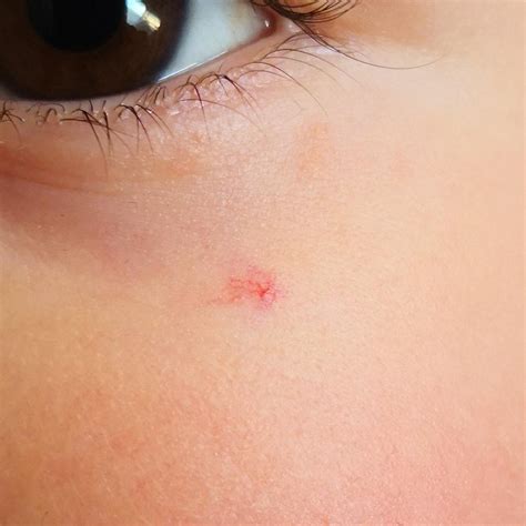 My 2 year old have this red dot on her cheek for two months. Do i need to be concerned? : r ...