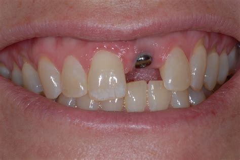 Dental Implant Front Tooth at Nelson Roberto blog