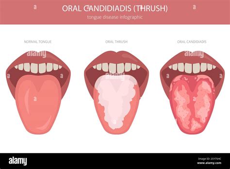 Oral thrush. Oral candidiadis disease. Medical infographic design ...