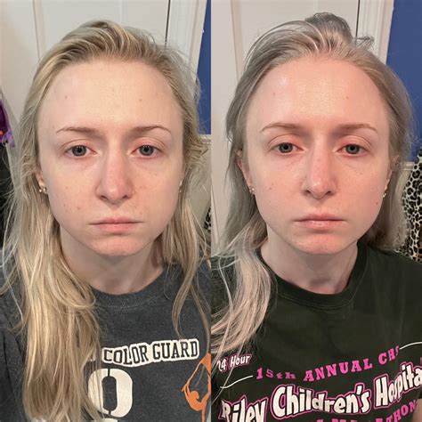 dry skin around mouth : r/tretinoin