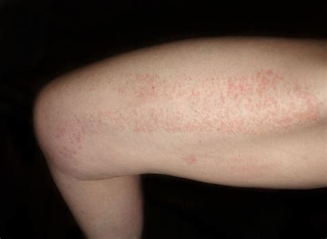 Red Spots on Skin: Causes, Diagnosis, and Treatments