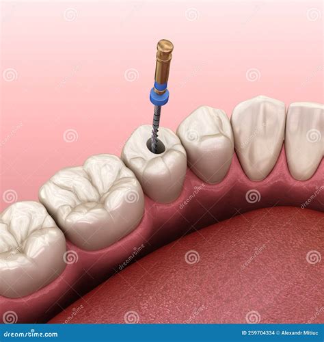 Endodontic Abscess Drainage at Laverne Haskins blog