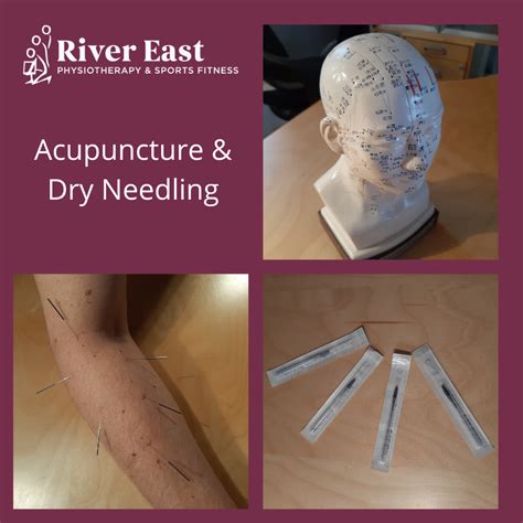 Is Acupuncture Similar To Dry Needling at Lucy Dean blog