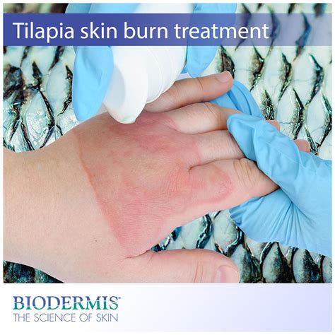 Skin Burn