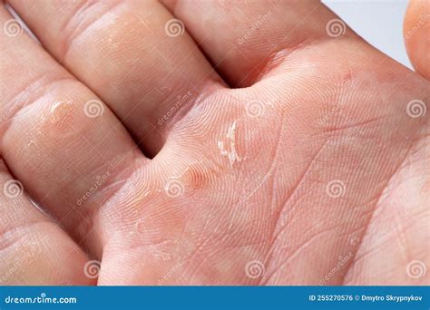 Hand Callus Pictures at Frank Keith blog