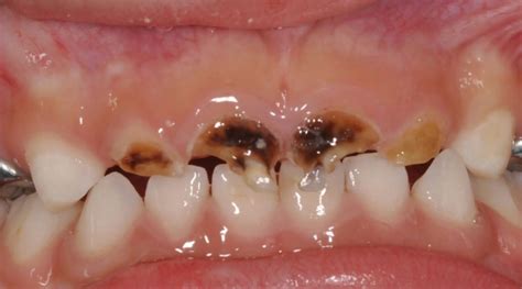 Caries de Biberón - Clinica Dental Sonrisa Segura