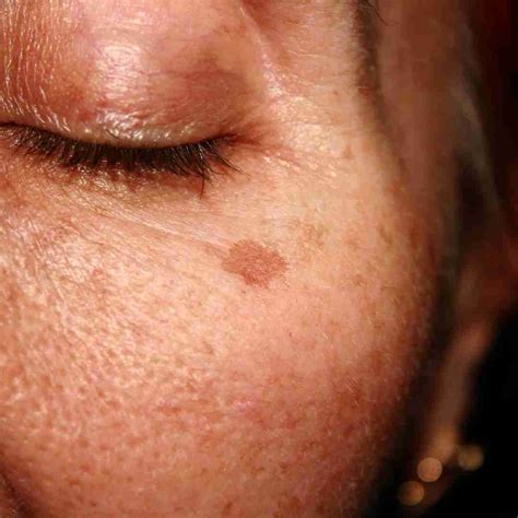 Dark Spots on Face - Organic Apoteke