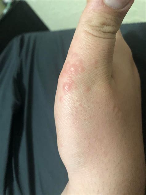 Why Do I Have Painful Bumps On My Hands at Melissa Dunphy blog