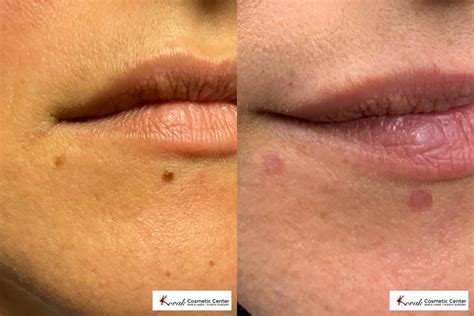Mole Removal Before And After
