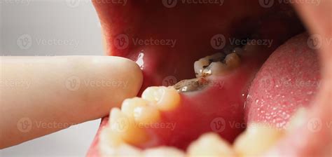 Decayed tooth root canal treatment. Tooth or teeth decay of lower molar. 11272265 Stock Photo at ...